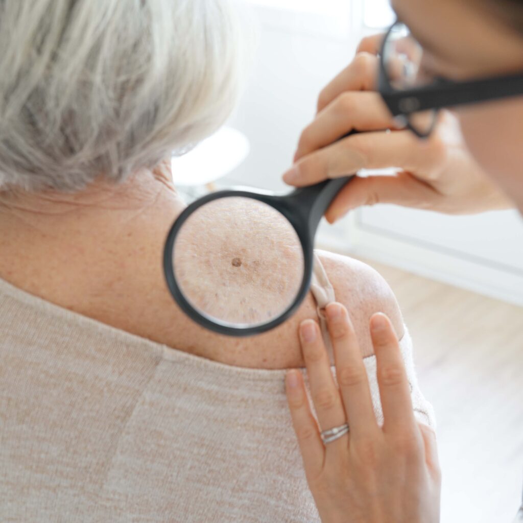 doctor looking at mole on patient's should with magnifying glass