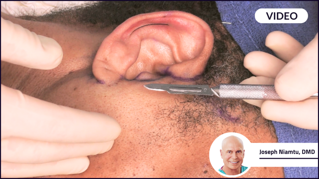 Patients face with a #15 surgical blade near it about to perform a facelift
