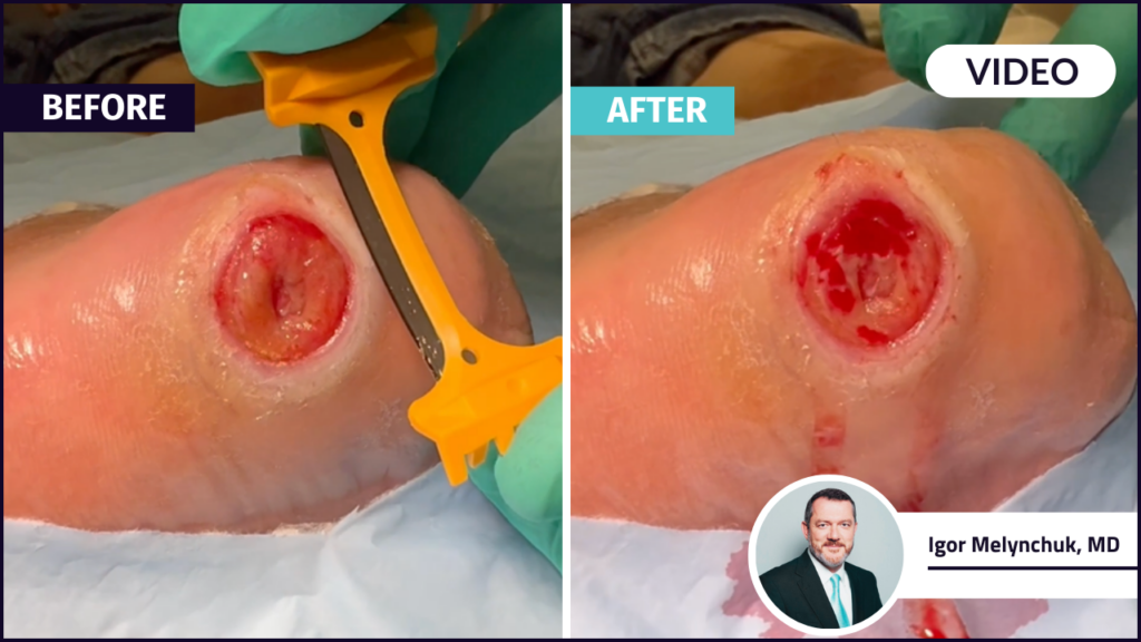 A before and after of a diabetic foot ulcer DFU after debridement by the DebrideBlade