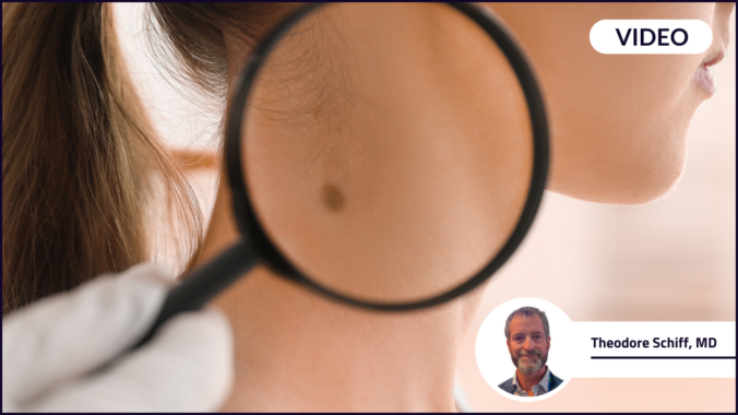 A magnifying glass looking at a mole on a woman's neck. Commonly used in dermatology to check for skin cancer and if Mohs surgery is required.