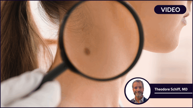 A magnifying glass looking at a mole on a woman's neck. Commonly used in dermatology to check for skin cancer and if Mohs surgery is required.
