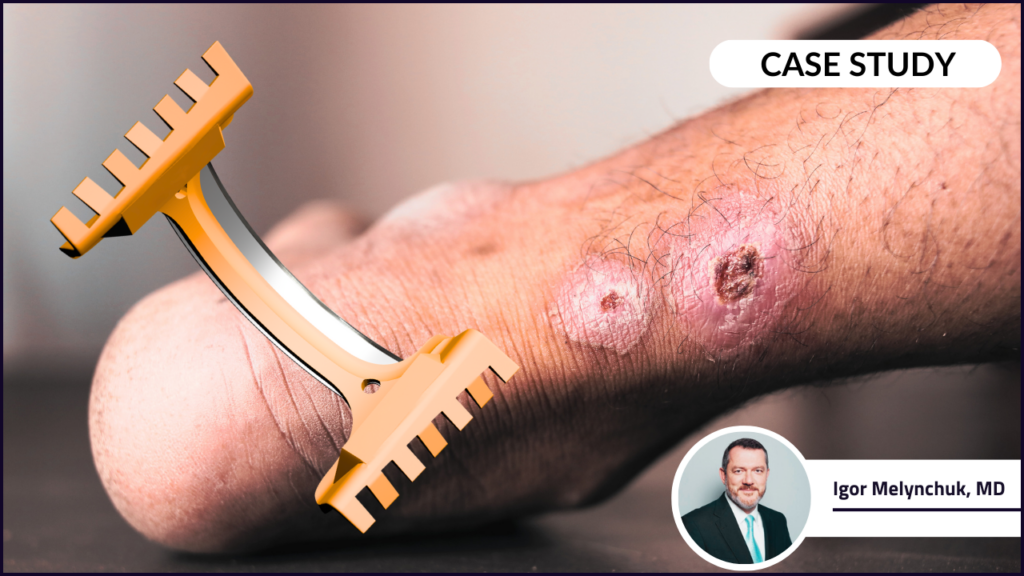 A foot wound and a DebrideBlade featuring a case study on the diabetic foot ulcer DFU