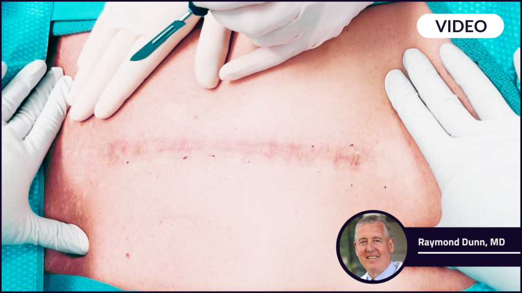 Dr. Raymond Dunn in front of a sternum scar they are about to perform a Sternotomy on.