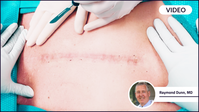 Dr. Raymond Dunn in front of a sternum scar they are about to perform a Sternotomy on.