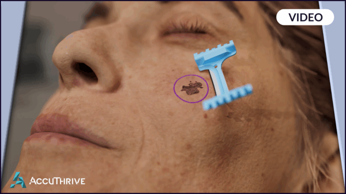 Image of a DermaBlade being used in Mohs Surgery