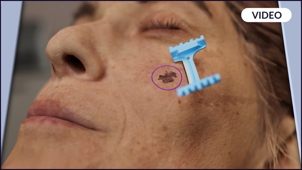 Image of a DermaBlade being used in Mohs Surgery