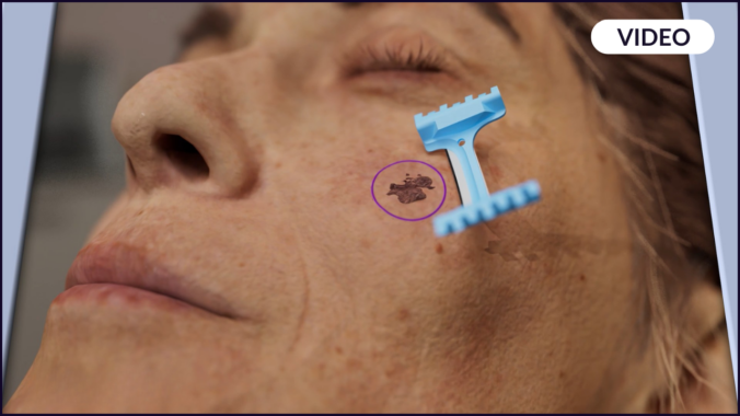 Image of a DermaBlade being used in Mohs Surgery