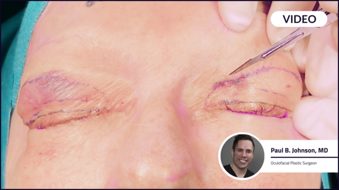 Paul B Johnson, MD performs an upper blepharoplasty using an AccuThrive #15 blade.